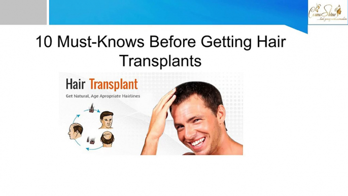 10 Must-Knows Before Getting Hair Transplants