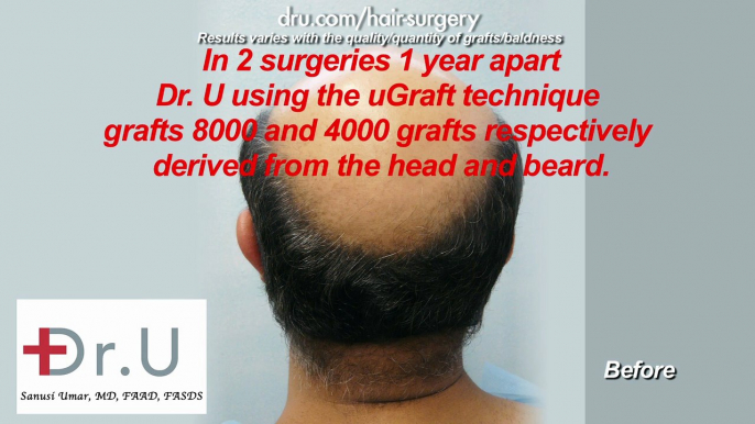 BEST NW 7 Hair Restoration in Los Angeles with Dr. Umar using Dr.UGraft