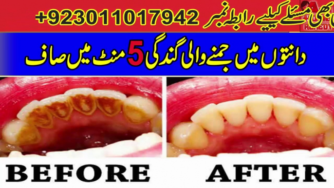 Dental Plaque Homemade Treatment In Just 5 Minutes | Teeth Whitening Tips In Urdu/Hindi