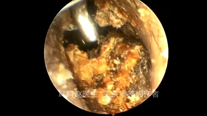 12 part Earwax Removal, Extractions 12段耵聍清理的大合辑，外耳道挖耳屎清理 耳垢 耳垢