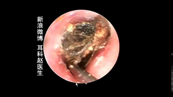 Earwax Removal, Extractions From A young Lady 一位女青年的右耳，外耳道挖耳屎清理 耳垢 耳垢