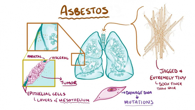 Mesothelioma - causes, symptoms, diagnosis, treatment, pathology - YouTube