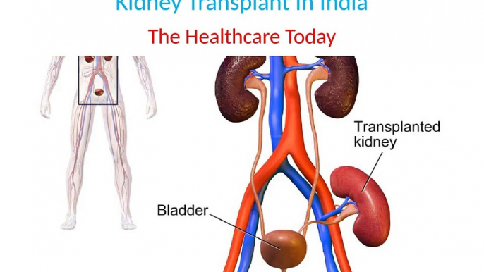 Kidney Transplant In India