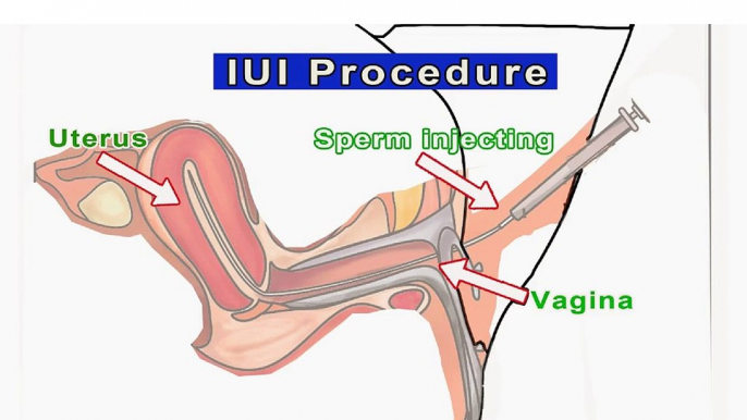 IUI Treatment in Hyderabad – IUI Infertility Centre in Hyderabad