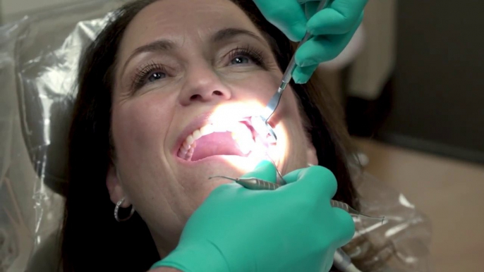 No-Prep Veneers: Conservative Treatment for Impressive Results