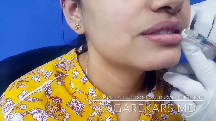 Lip Fillers Treatment At Garekar's Skin Clinic In Gurgaon