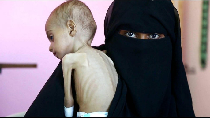 19 million Yemeni children suffer malnutrition and illness