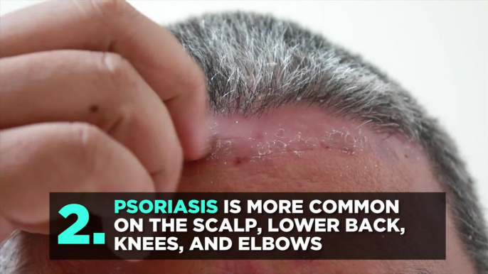 The Key Differences Between Eczema and Psoriasis You Need to Know