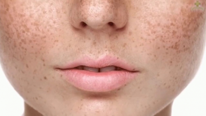 How To Treat Pigmentation Permanently