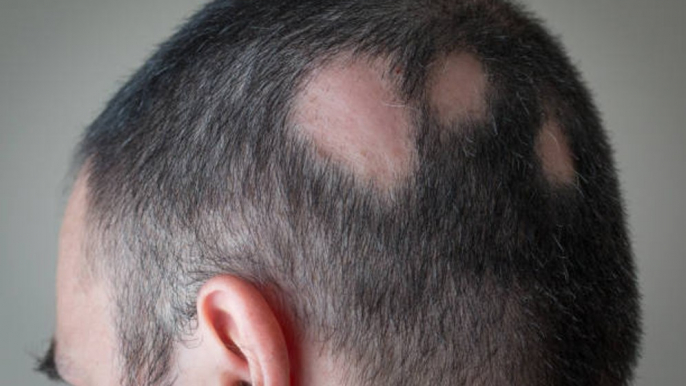 ¿Qué es la Alopecia?