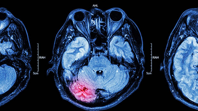 La actividad cerebral excesiva ligada a una vida más corta