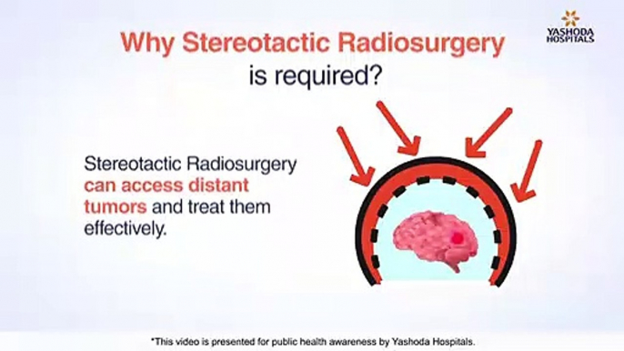 Gamma Knife (Stereotactic Radiosurgery) Treatment for Tumors in Brain, Neck, Lungs, and Liver