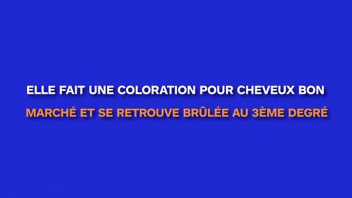 Elle utilise une coloration pour cheveux bon marché et se retrouve avec le cuir chevelu brûlé au troisième degré