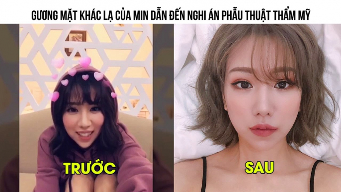 GƯƠNG MẶT KHÁC LẠ CỦA MIN DẪN ĐẾN NGHI ÁN PHẪU THUẬT THẨM MỸ