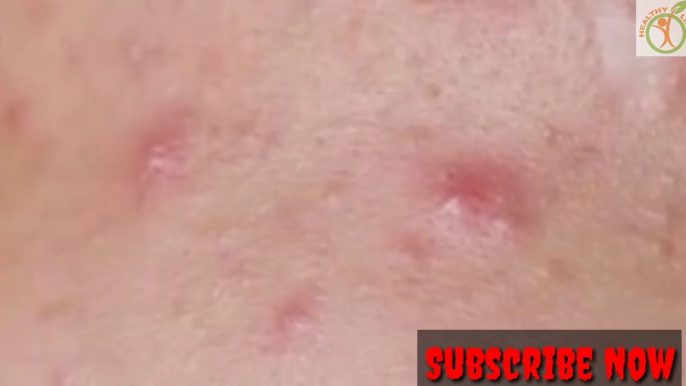 How To Get Rid Of Pimples and Acne Naturally At Home