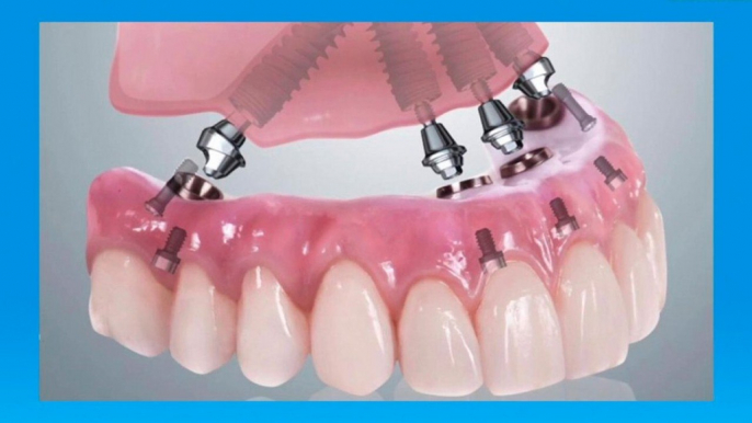 bd-tipos-de-protesis-dentales-061120
