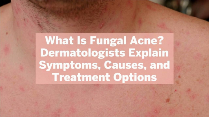 What Is Fungal Acne? Dermatologists Explain Symptoms, Causes, and Treatment Options