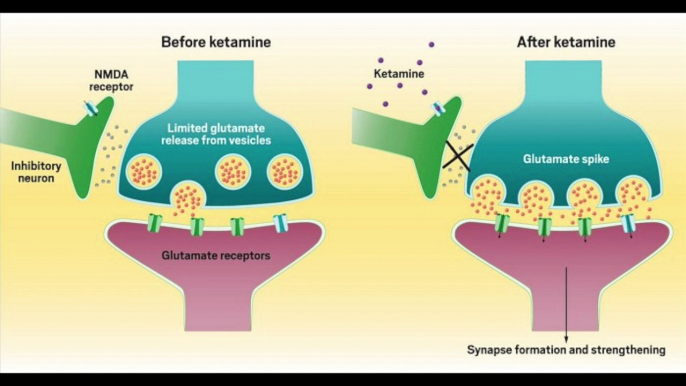 Ketamine Infusion | Latest Treatment For Suicidal Depression Alcohol Opioid Cocaine Addiction