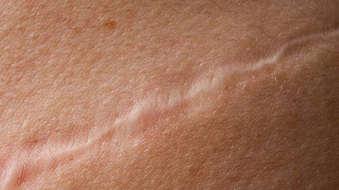 Hypertrophic scars explained: Why they occur and how to treat them