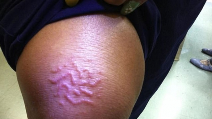 She thought she had a rash but what was really in her leg was something much more horrifying