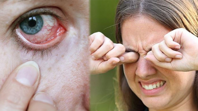 Winter में आंखों का सूखापन कैसे दूर करें | ठंड में Dry Eye से बचने के उपाय | Boldsky *health
