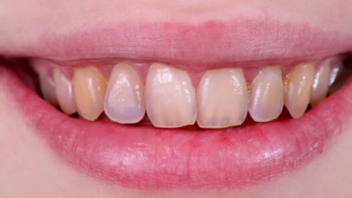 Cómo Blanquear Los Dientes En 2 Minutos _ @UnDentista _ Dientes Amarillos a Blancos_