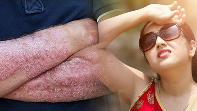 Sun Poisoning क्या होता है ? Sun Poisoning Symptoms और Reason । Boldsky