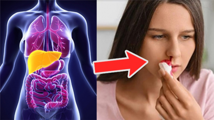 नकसीर फूटने के कारण Fatty Liver Symptoms, Epistaxis Causes Reason जानना जरूरी | Boldsky