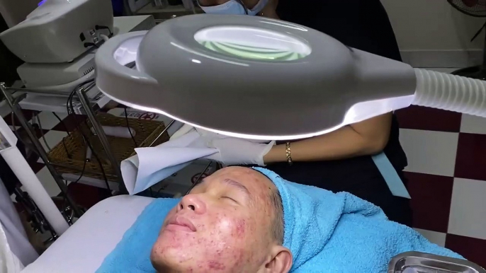 Big Cystic Acne Blackheads Extraction Blackheads & Milia, Whiteheads Removal Pimple Popping