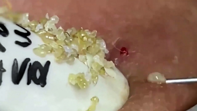 Blackheads- Pimples- Acne- Steatocystoma