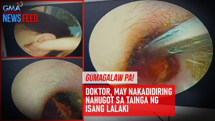 Gumagalaw pa! Doktor, may nakakadiring nahugot sa tainga ng isang lalaki | GMA Integrated Newsfeed