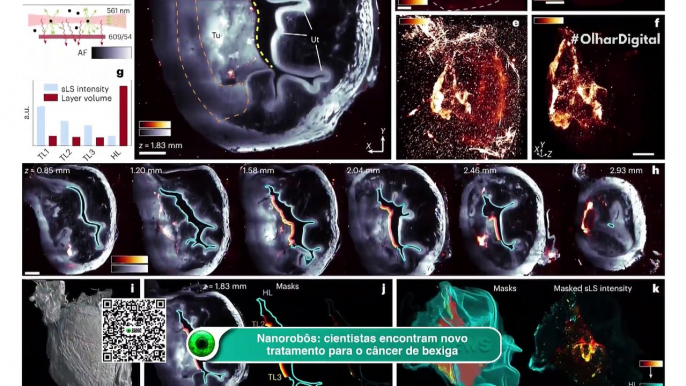 Nanorobôs cientistas encontram novo tratamento para o câncer de bexiga