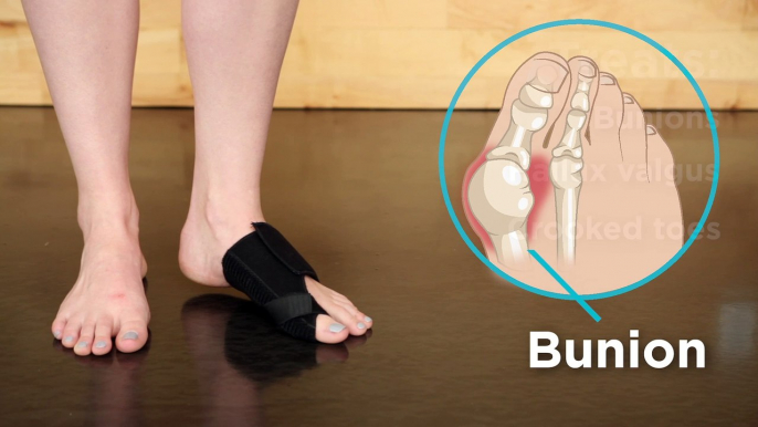 BraceAbility Bunion Corrector: How to Treat a Crooked Big Toe & Fix Hallux Valgus Without Surgery