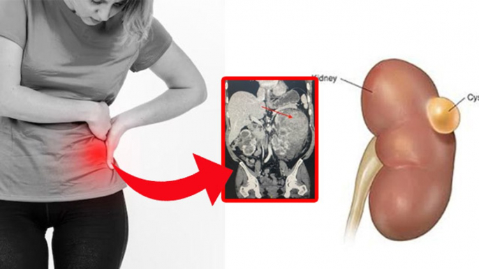 Kidney Cyst Kya Hota Hai: Symptoms, Pain & Treatment In Hindi | Boldsky